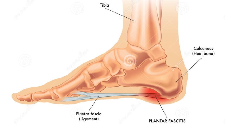 Nagging Heel Pain? What is Plantar Fasciitis? And How to Fix it - LiquidGym